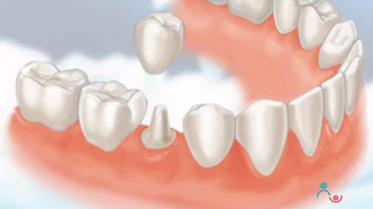 Ways to Handle Tooth Injury & Must-have Precautions in Teenagers