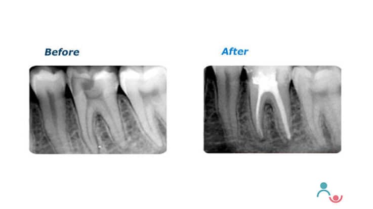 Are Root Canal Treatment (RCT) Needed? Causes, Signs & Therapy