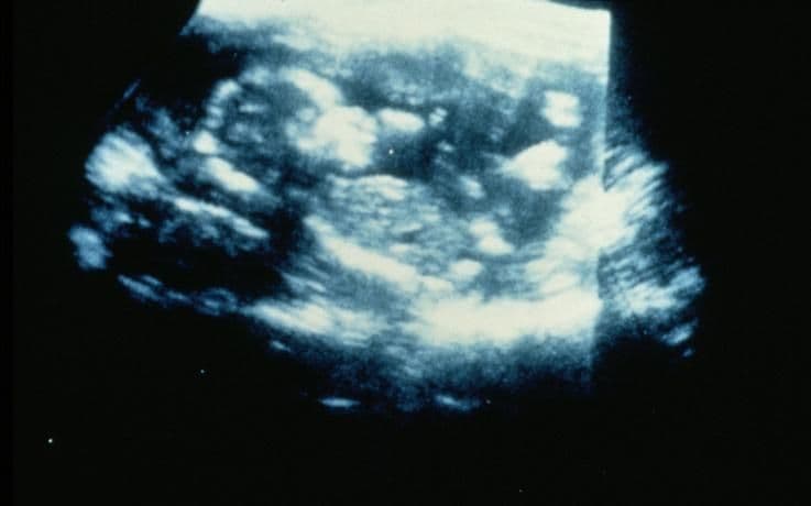 20 weeks and 4 days pregnant